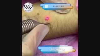 فیلم برداشتن خال با لیزر
