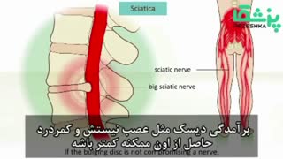همه چیز درباره کمر درد
