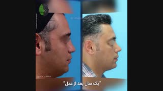 یکسال بعد از جراحی بینی پهن با مشکل دریچه ای زینی نسبی | دکتر باستانی نژاد | جراح بینی