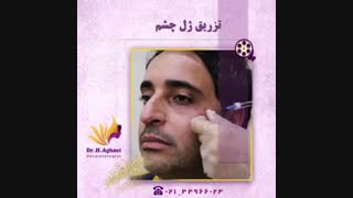 تزریق ژل زیر چشم جراحی بینی