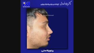 فیلم رینوپلاستی