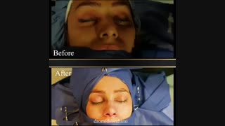 نمونه کار جراحی بینی دکتر امید ابراهیمی