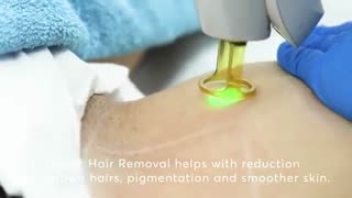 لیزر موهای زائد بر روی پوست لیزر فرکشنال