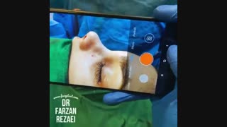 در این فیلم می توانید مزیت جراحی بینی بسته را نسبت به جراحی باز ببینید