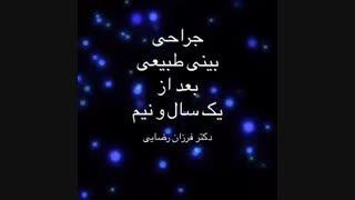 نمونه عمل بینی طبیعی بعد از یک سال و نیم