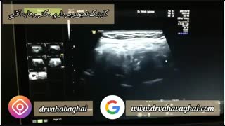 سونوگرافی تیروئید چیست و چه کاربردهایی دارد؟