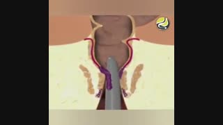 فیلم جراحی بواسیر
