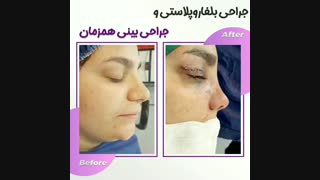 جراحی همزمان بینی و پلک