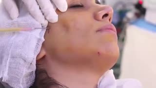 همه چیز درباره تزریق چربی لیزر صورت