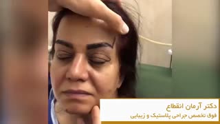 فیلم لیفت ابرو همزمان با عمل زیبایی پلک