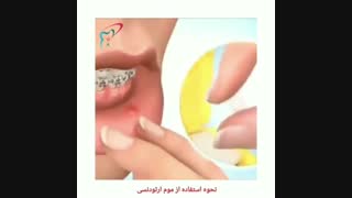 نحوه استفاده از موم ارتودنسی