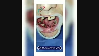جراحی ۶ واحد ایمپلنت در فک پایین