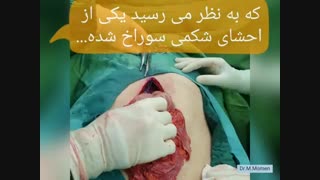 آیا زخم معده سوراخ می شود؟ (جراحی زخم معده)
