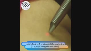 فیلم واقعی رفع مشکلات پوستی با لیزر فوتونا کلینیک مو