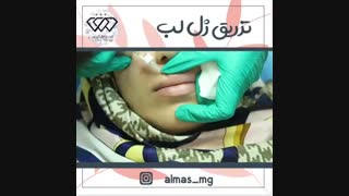 فیلم واقعی تزریق ژل با بهترین برند موجود