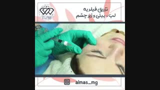 فیلم واقعی تزریق فیلر بینی، لب و زیر چشم