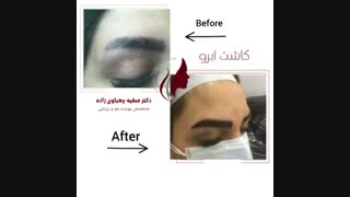 فیلم واقعی کاشت ابروی طبیعی