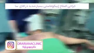 جراحی ژنیکوماستی با حداقل برش