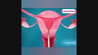 فیلم نحوه قرارگیری آى یو دى (IUD) ، دستگاه جلوگیرى از باردارى