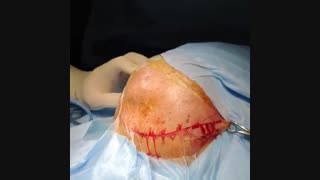 تومور بزرگ تهاجمی مننژیوم