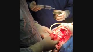 تومور گلیوم فرونتال