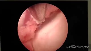 عمل آندوسکوپی کیست کلوئید