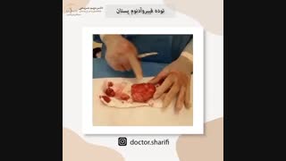 فیلم واقعی جراحی توده فیبروآدنوم پستان