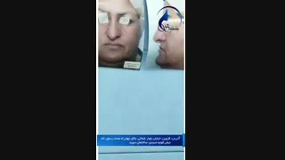 جراحی زیبایی بینی گوشتی و افتاده