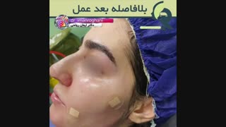تزریق چربی صورت اصلاح فرم صورت