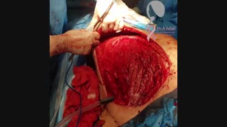 جراحی سرطان سینه با گستردگی وسیع پوست