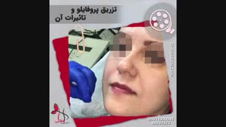 فیلم تزریق پروفایلو و تغییرات جالب بیمار