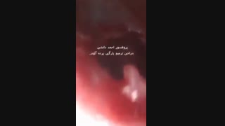 جراحی ترمیم پارگی پرده گوش