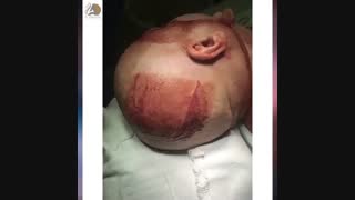 فیلم واقعی جراحی تومور مغزی - متاستاز با منشاء سرطان تخمدان