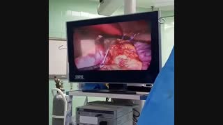 عمل جراحی چاقی