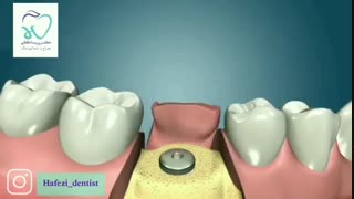 ایمپلنت دندان