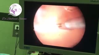 فیلم جراحی هیستروسکوپی سپتوم کوتاه