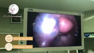 لاپاراسکوپی حاملگی خارج رحم