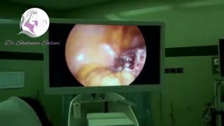 لاپاراسکوپی هیسترکتومی در خانم با وزن ۱۳4