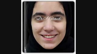 درمان ارتودنسی بدون کشیدن دندان | دکتر سعید قریشی