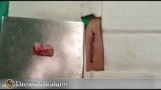 استفاده از غضروف دنده برای جراحی بینی ترمیمی توسط دکتر امید ابراهیمی