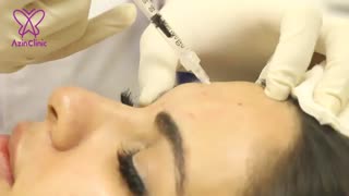 تزریق بوتاکس لمینت