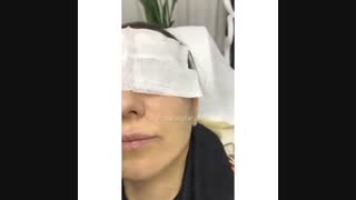 فیلم زاویه سازی فک