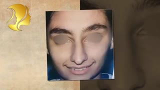 قبل و بلافاصله بعد از جراحی بینی