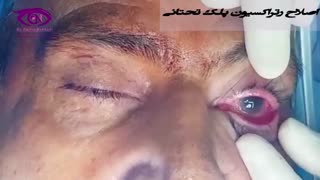 فلیم واقعی اصلاح رتراکسیون پلک تحتانی