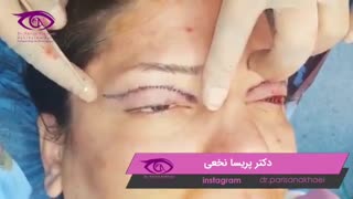 فیلم واقعی جراحی بلفاروپلاستی