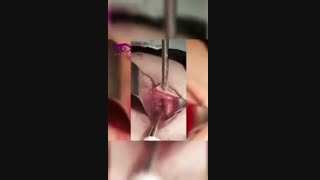 ویدئو واقعی شکستگی وسیع کف و ریم حدقه چشم