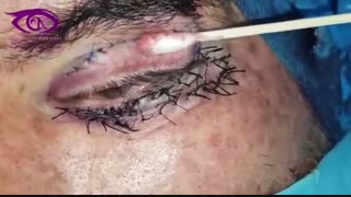 فلج عصب صورت facial nerve palsy