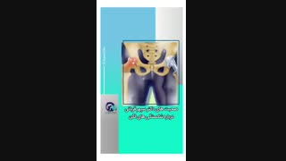 درمان شکستگی های لگن در افراد سالمند