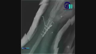 شکستگی داخل مفصلی