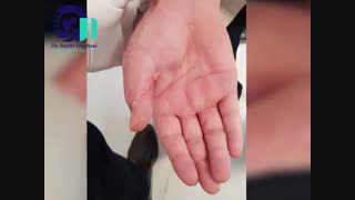 جراحی بازسازی بافت نرم و انتقال تاندون از مچ دست